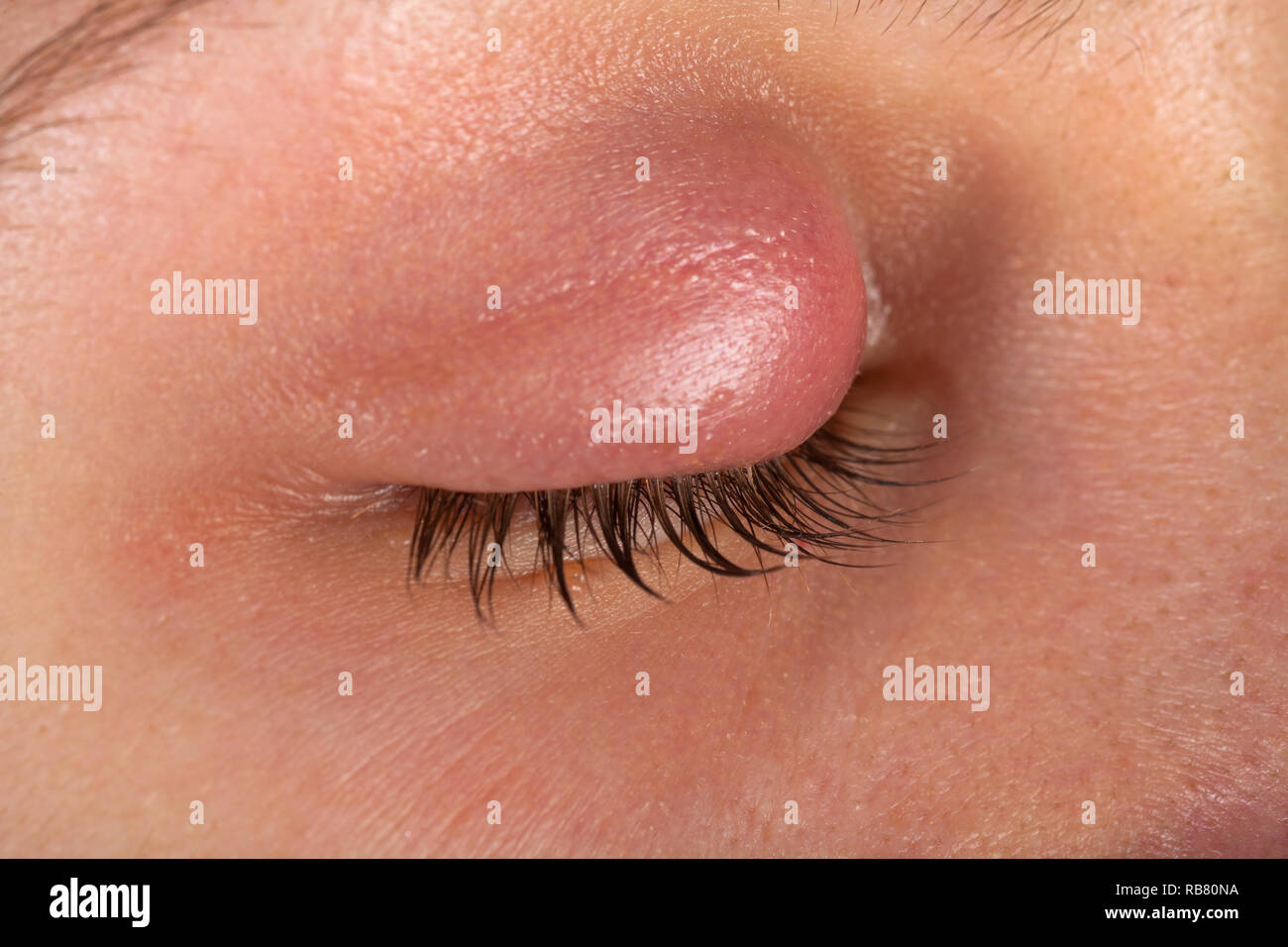 Pus Abscess Stock Photos Pus Abscess Stock Images Alamy