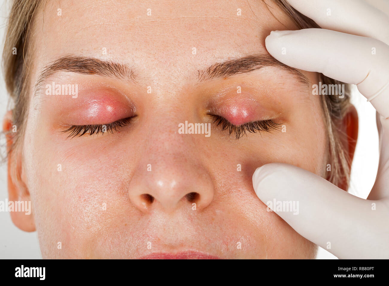Female patients ophthalmic infection. Hordeolum on upper eyelid, shown