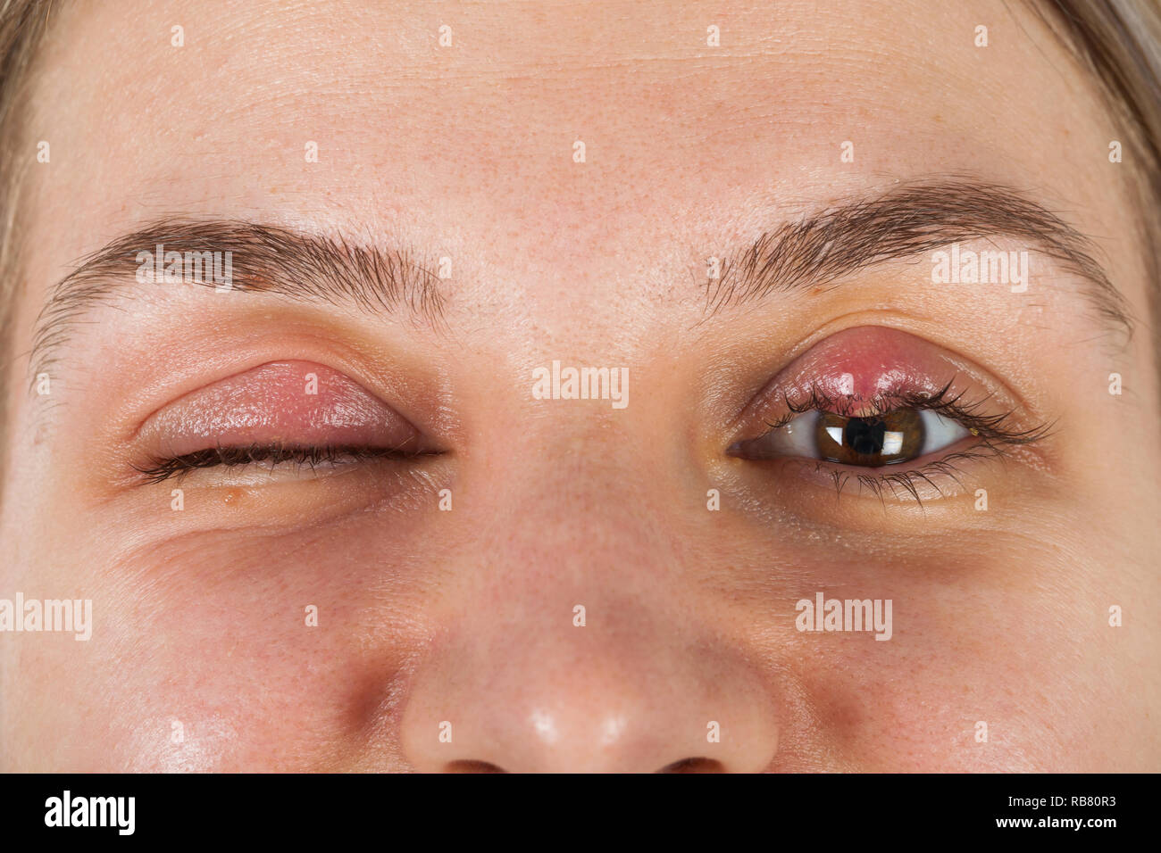Close up picture of female patient's infected eye. Hordeolum on upper