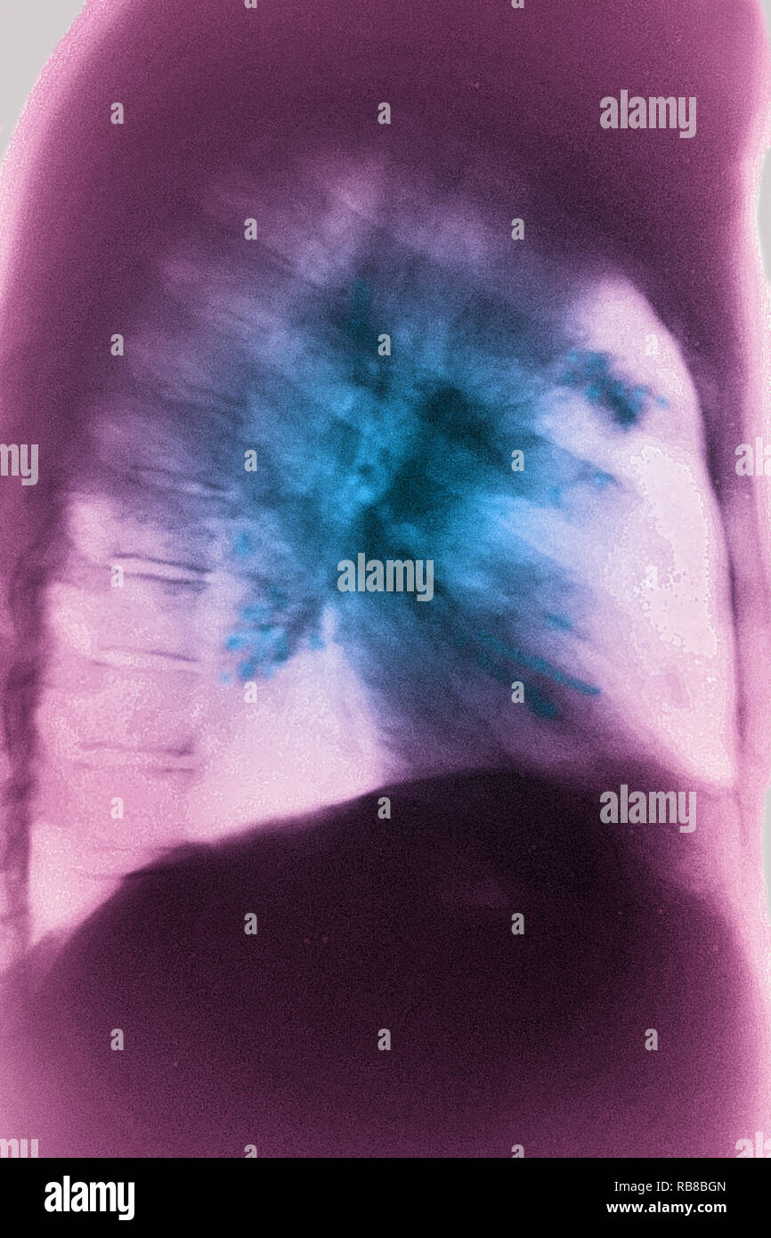 LUNG CANCER XRAY Stock Photo Alamy