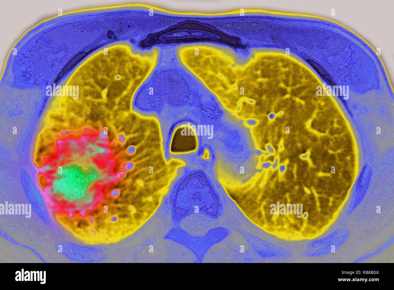 LUNG CANCER MRI Stock Photo