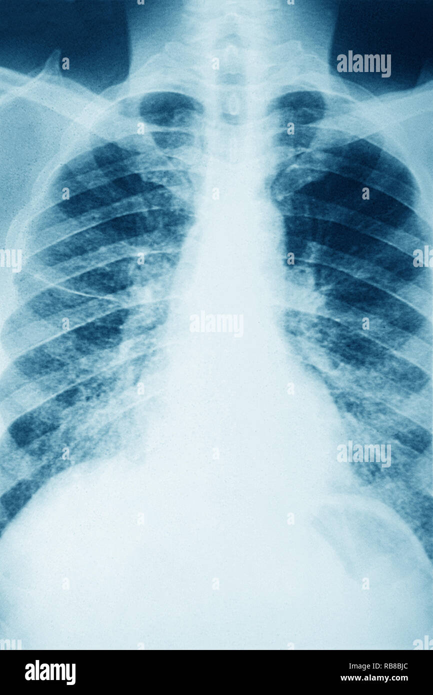 SARCOIDOSIS, XRAY Stock Photo Alamy