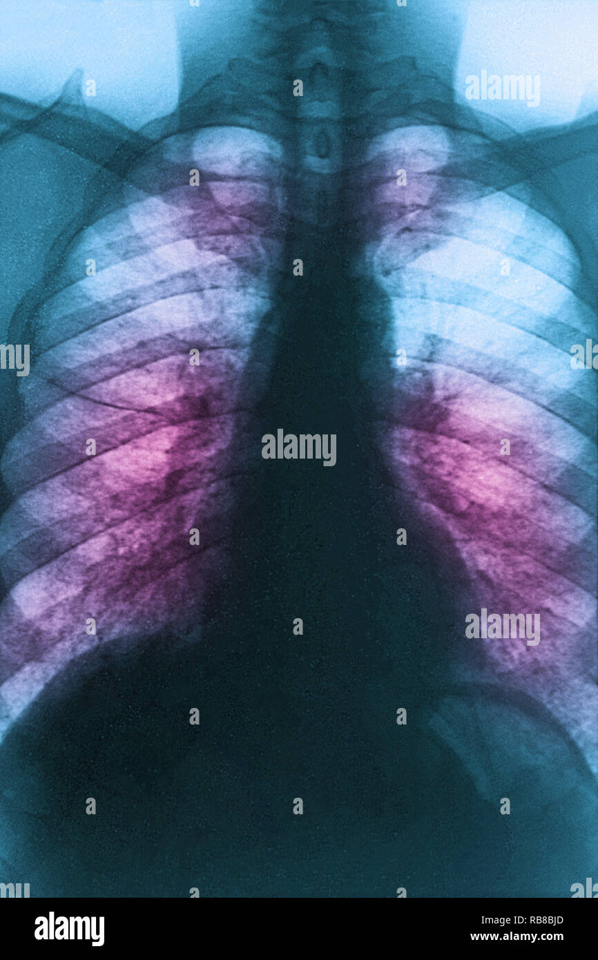 SARCOIDOSIS, XRAY Stock Photo Alamy