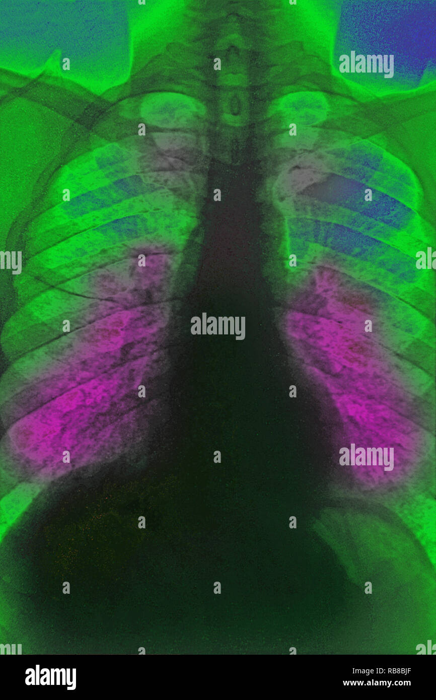 SARCOIDOSIS, XRAY Stock Photo Alamy