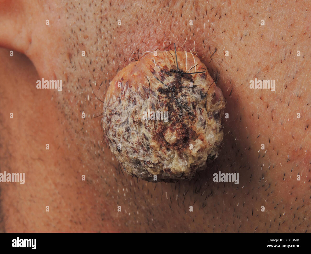 Benign facial tumors — photo 3