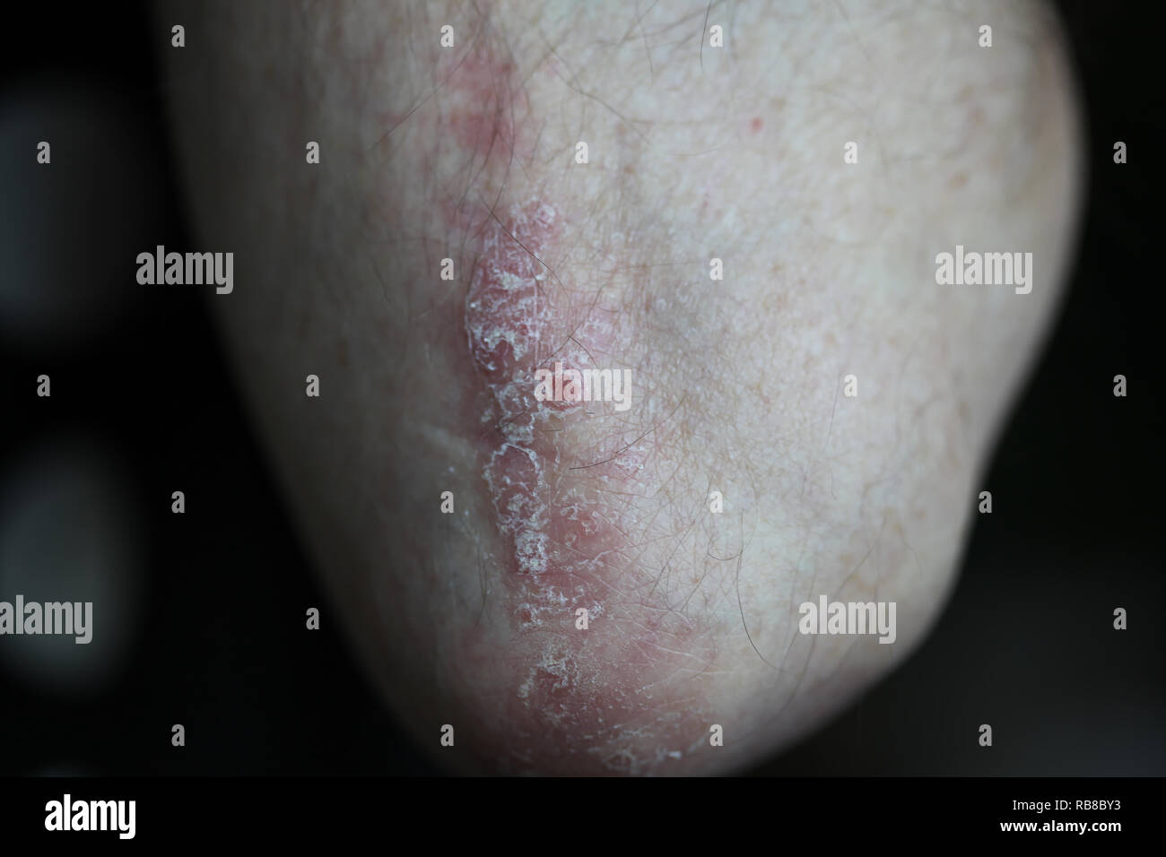 Psoriasis arm hi-res stock photography and images - Alamy