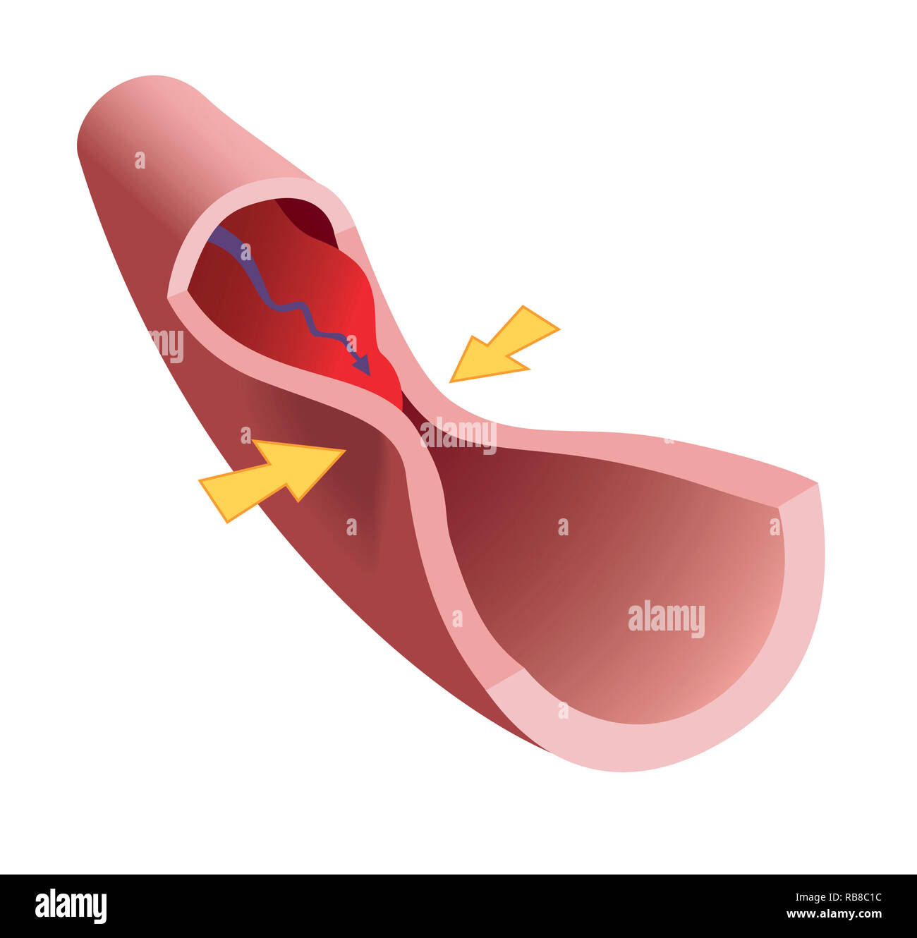 CORONARY ARTERY SPASM Stock Photo