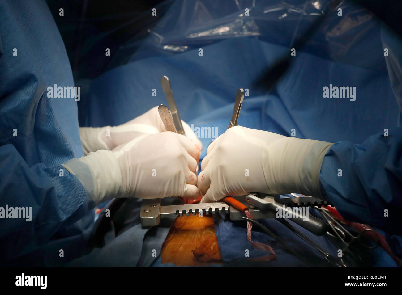 Cardiac surgery child hi-res stock photography and images - Alamy