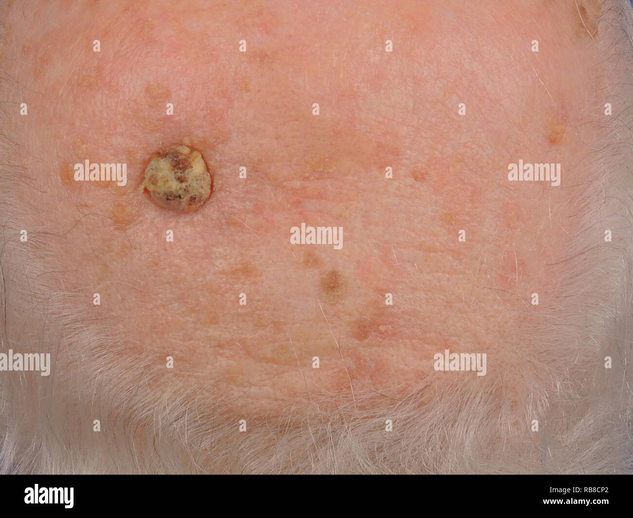 Epithelioma High Resolution Stock Photography And Images Alamy