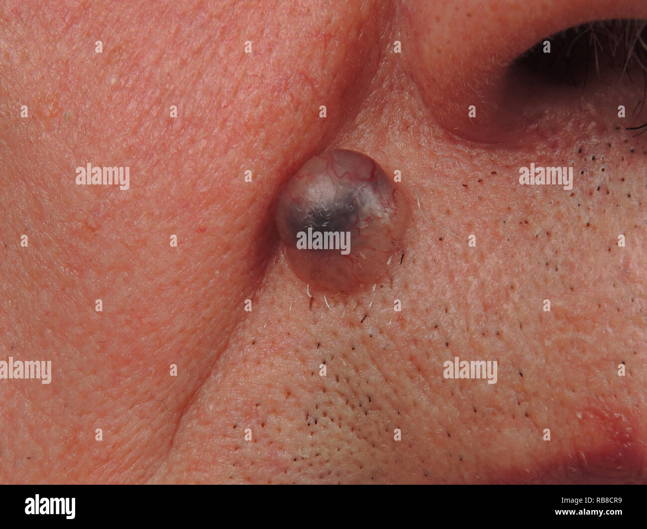 BASAL CELL CARCINOMA Stock Photo