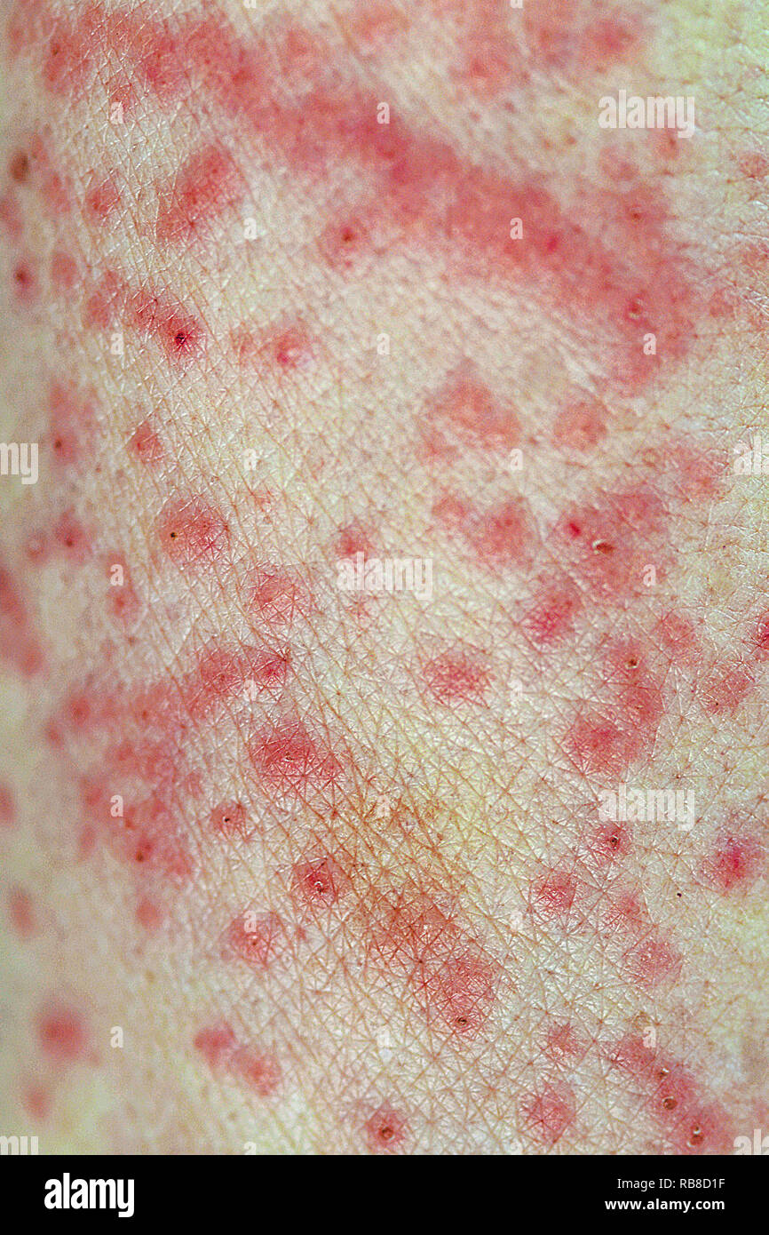 Contact dermatitis Stock Photo Alamy