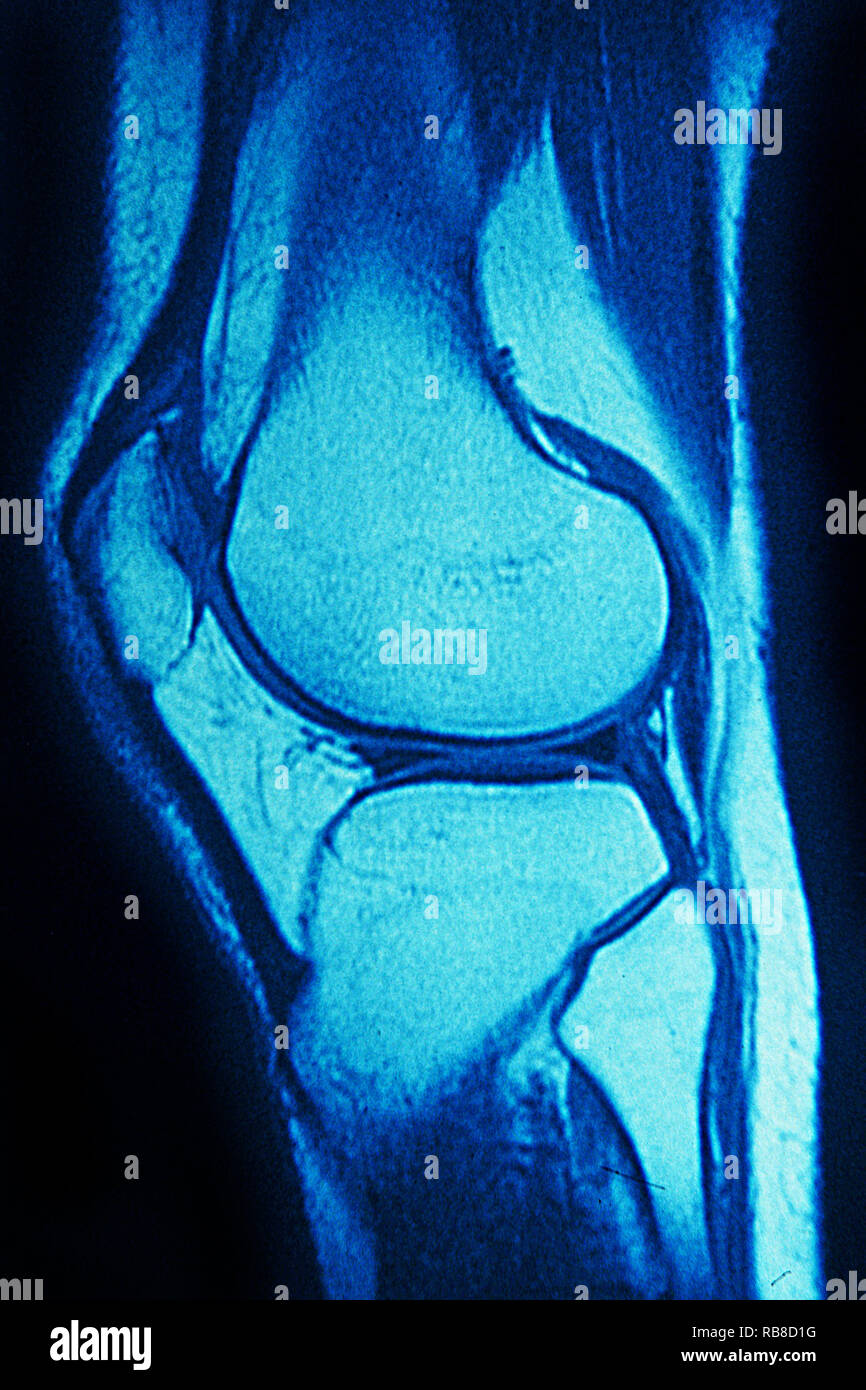 MRI normal knee Stock Photo