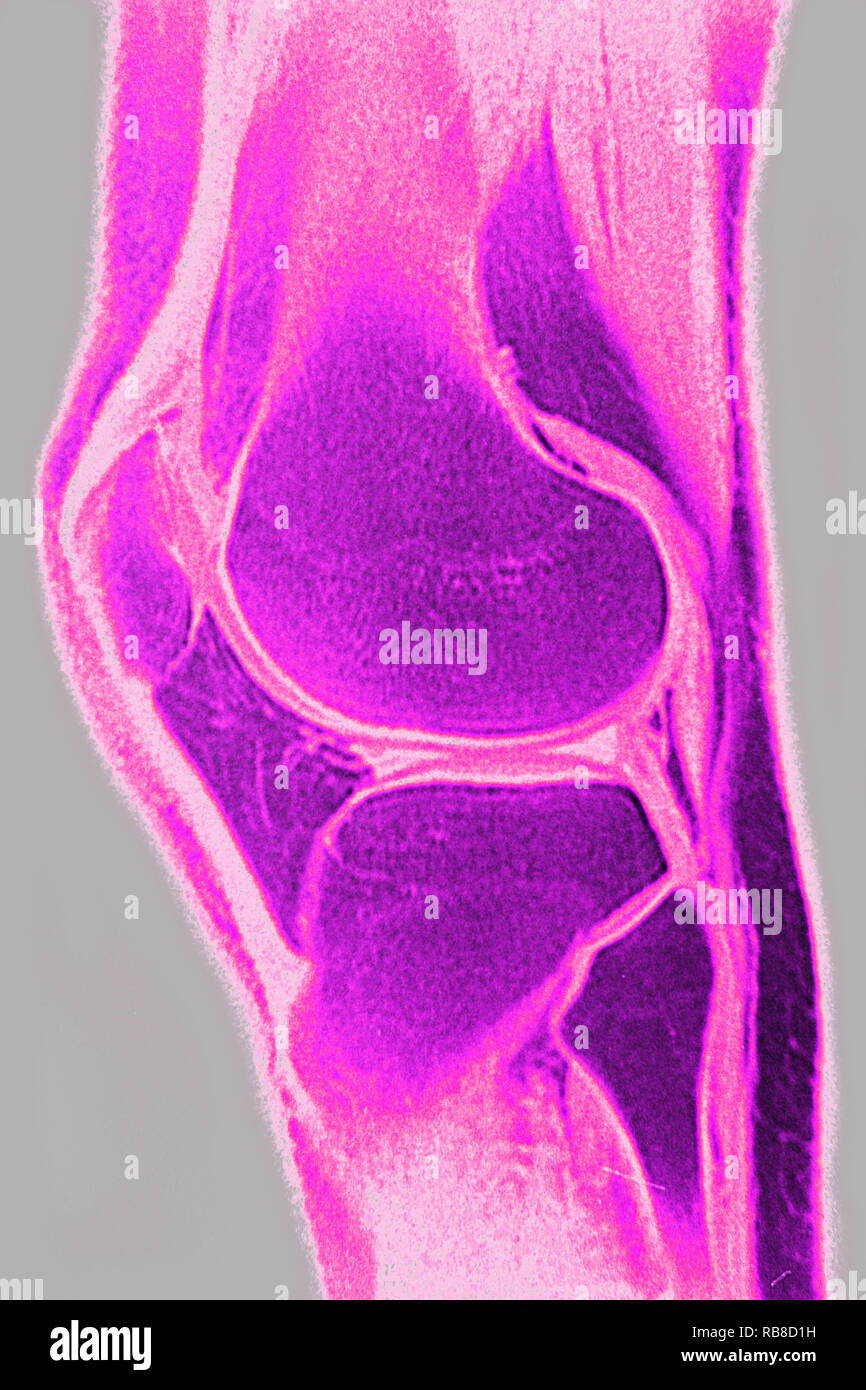 Normal knee seen on a sagittal section MRI scan. Stock Photo