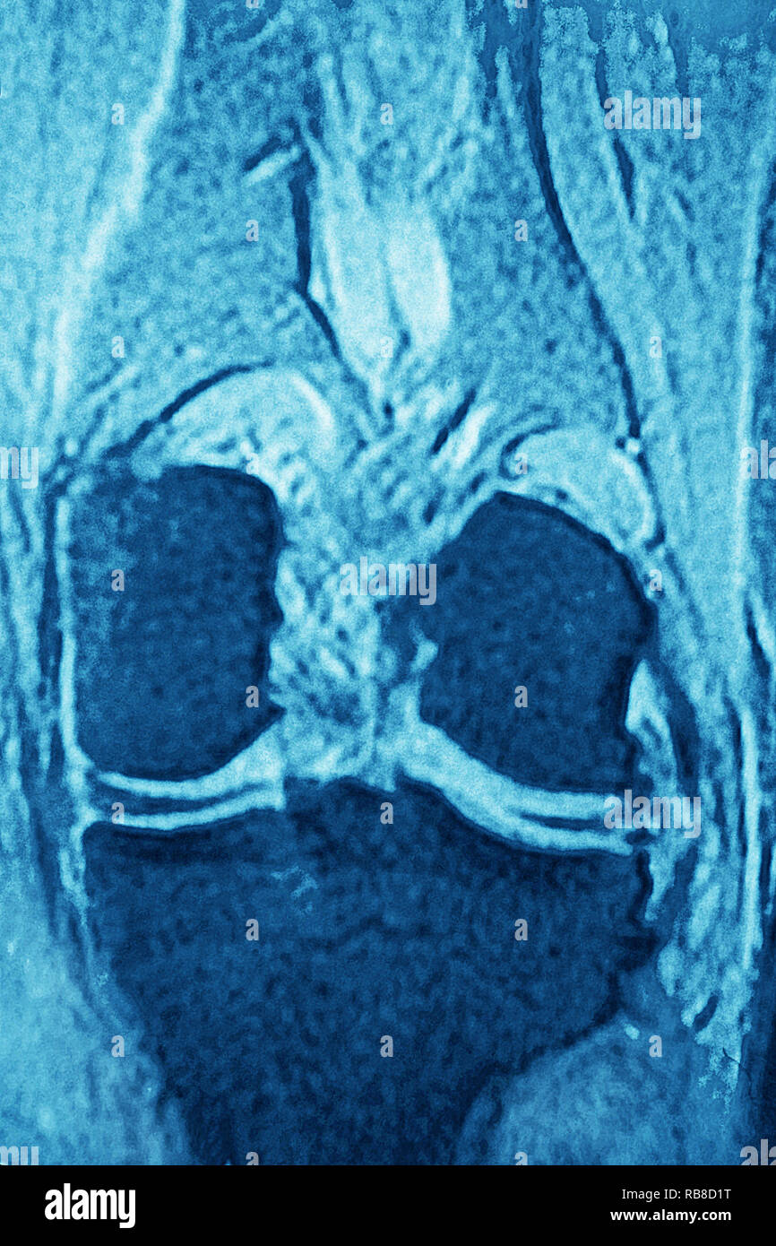 Normal knee MRI Stock Photo