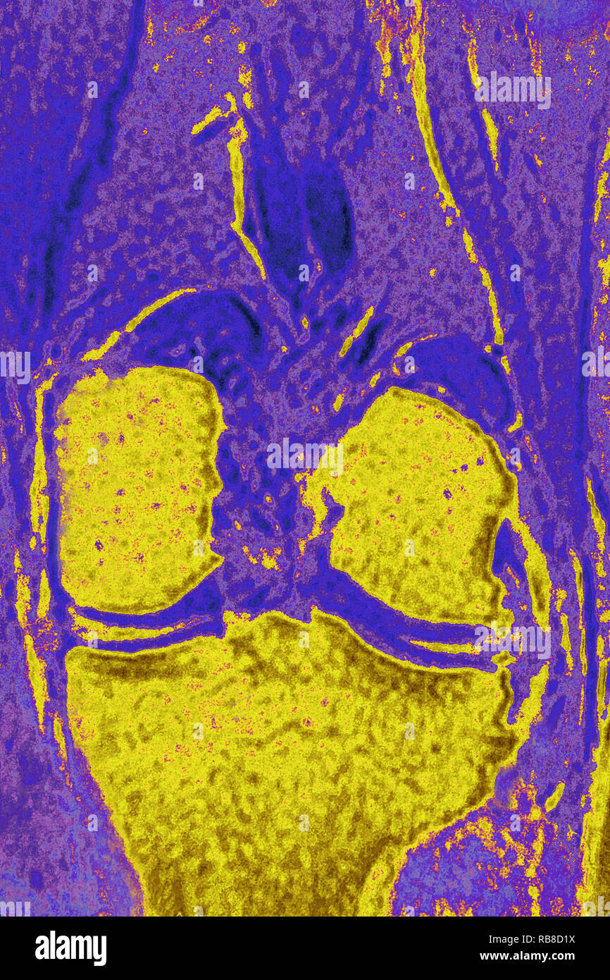 Normal knee MRI Stock Photo