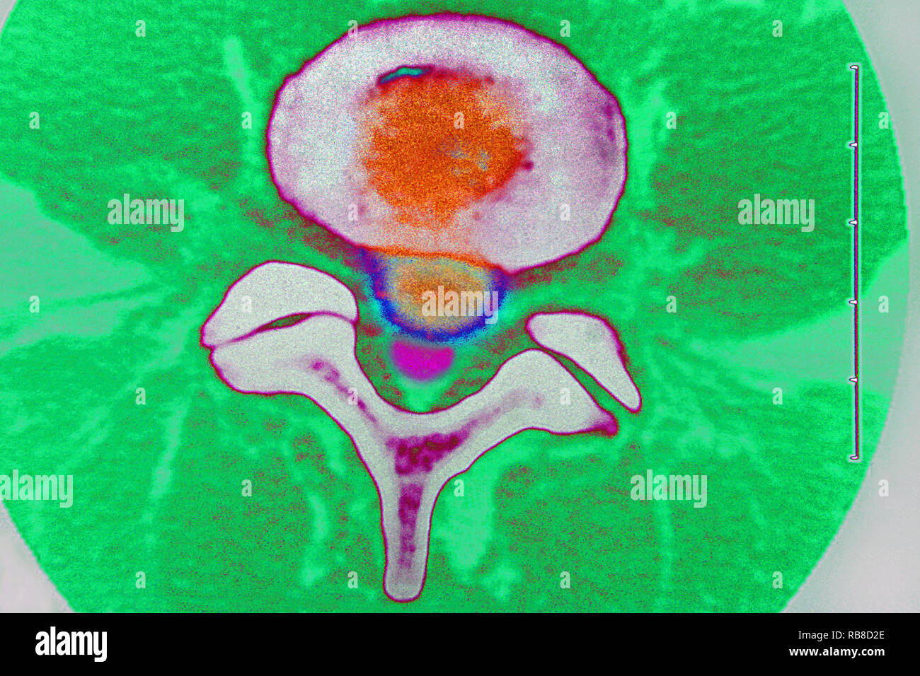 Vertebrae cross section hires stock photography and images Alamy