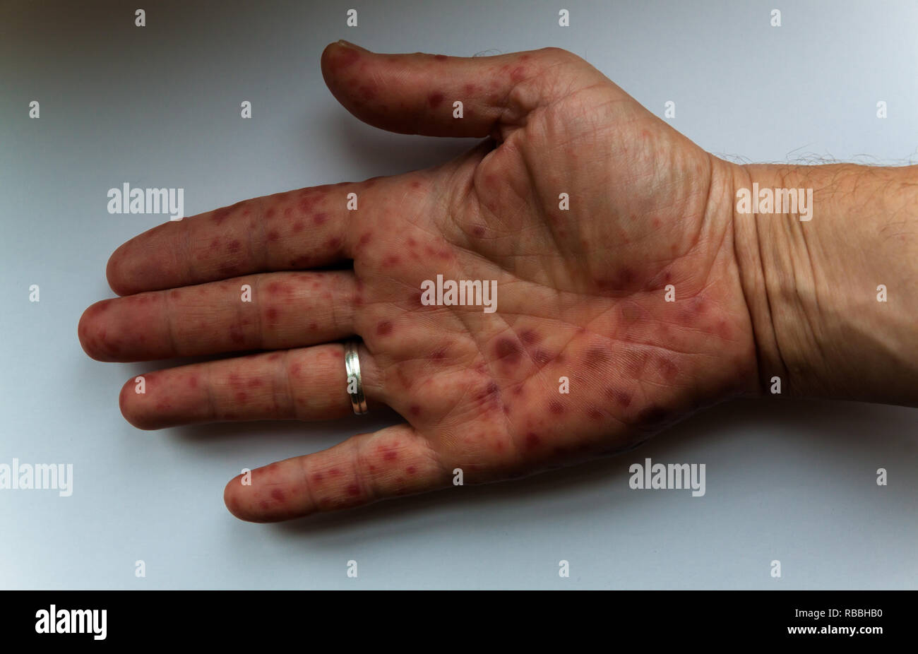 Hand mouth foot sickness Stock Photo