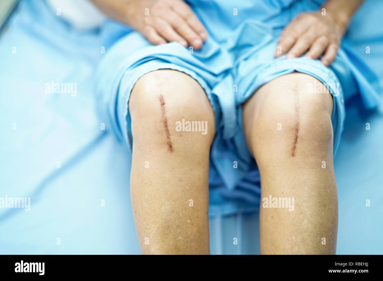 Knee Surgery Scar High Resolution Stock Photography And Images Alamy