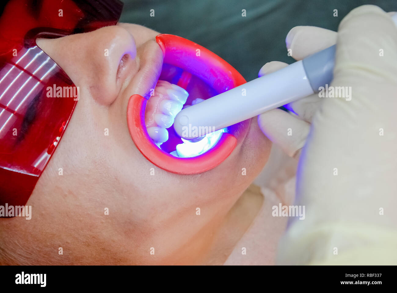 Patient with safety protective glasses and cheek retractor on. Laser light  lamp turn on as a procedure of Professional Teeth Whitening. Women's  Cosmetic and Aesthetic Dental Care Health Concept.healthy teeth whitening  procedure