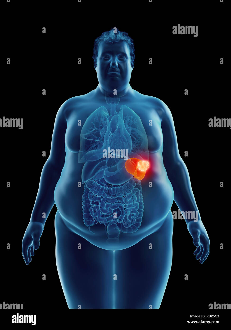 Illustration of an obese man's spleen tumor Stock Photo Alamy