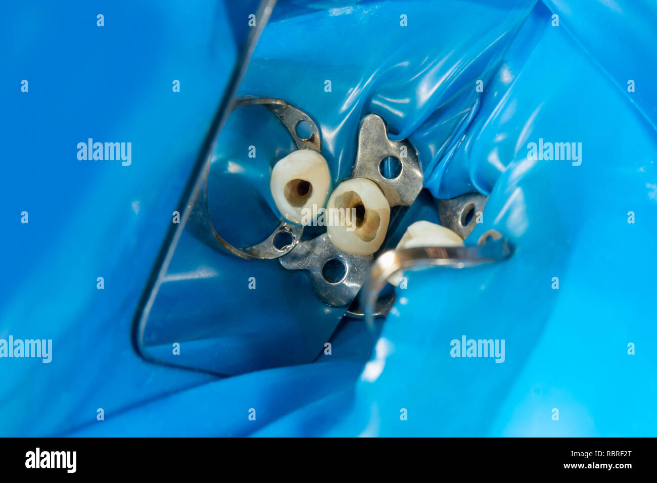 restoration of teeth after endodontic treatment with fiberglass pins