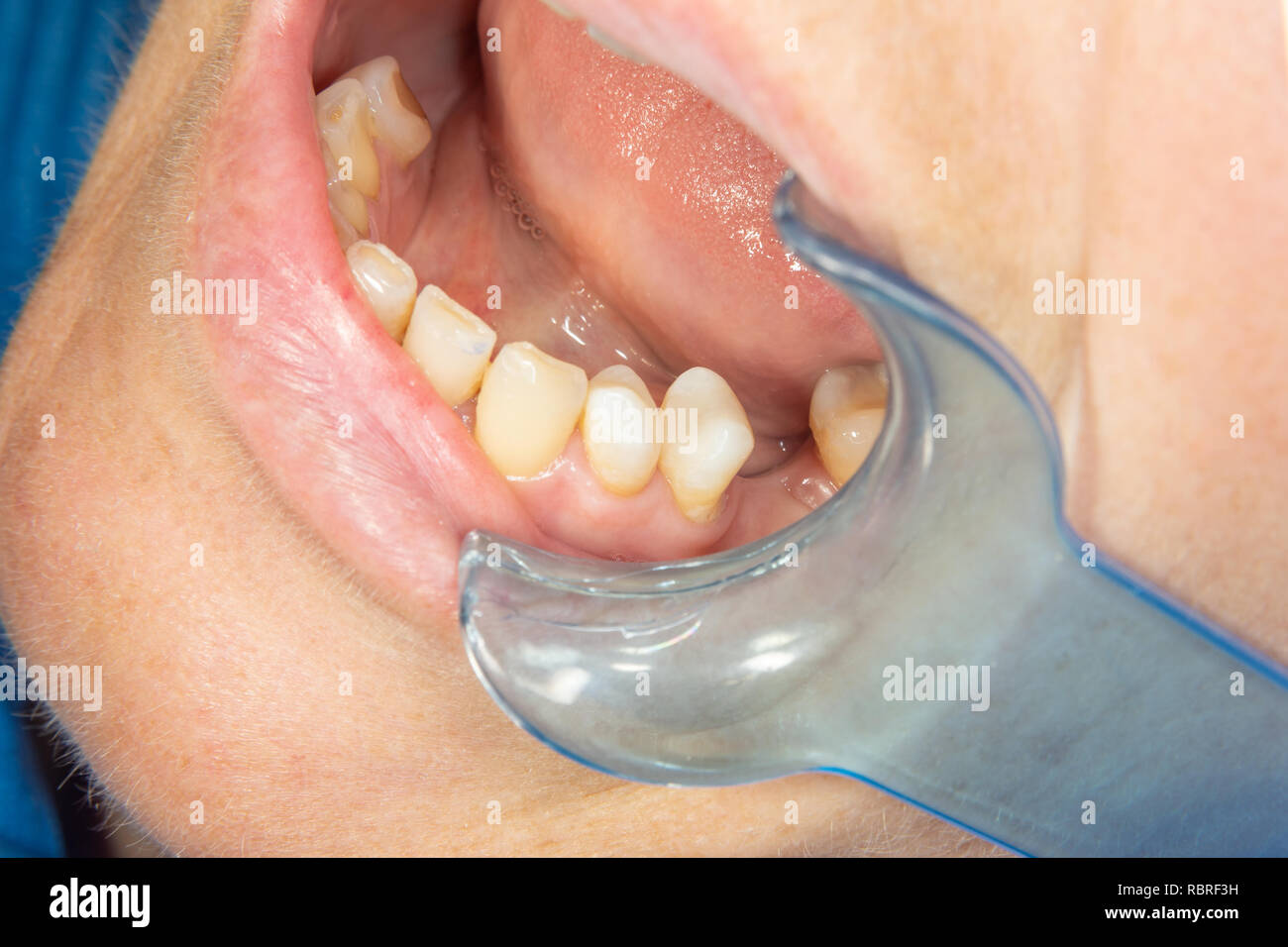 restoration of teeth after endodontic treatment with fiberglass pins