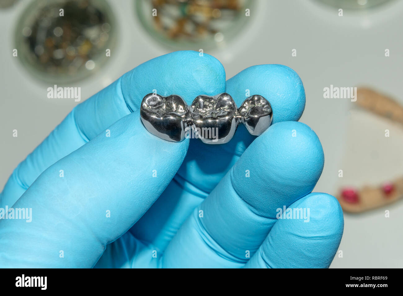 dental restoration of rotten roots of the teeth with ceramic crowns. cast posts dentistry Stock