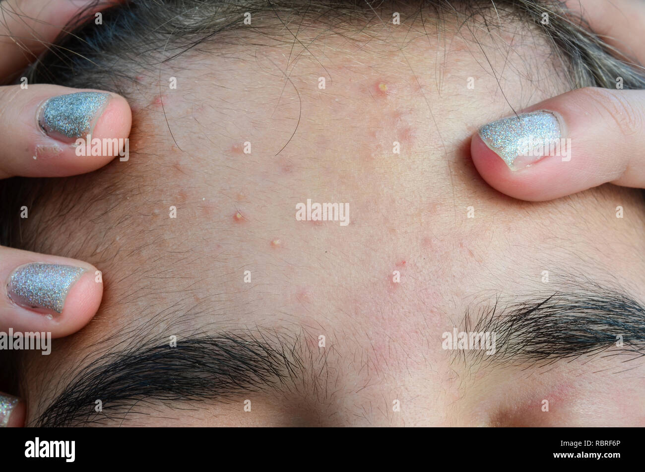 Macro shot of young girl's forehead with typical problem with acne and pimples at puberty Stock Photo