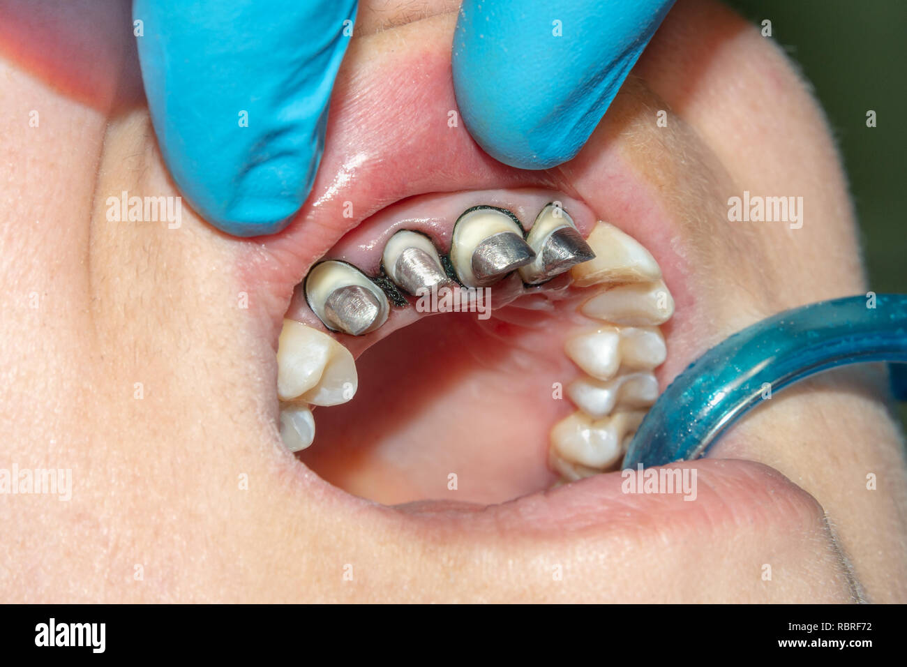 dental restoration of rotten roots of the teeth with ceramic crowns