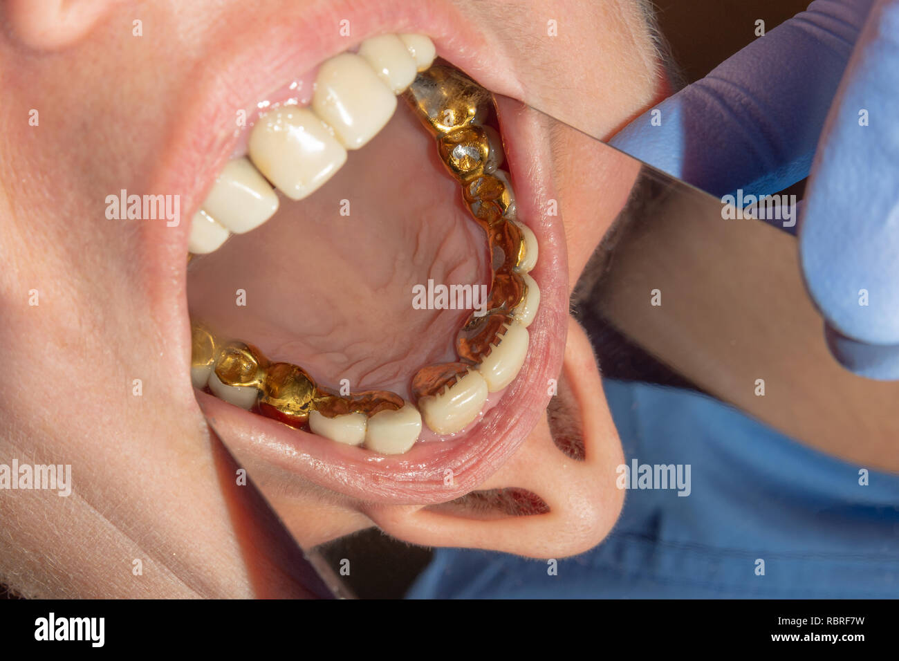 dental restoration of rotten roots of the teeth with ceramic crowns ...