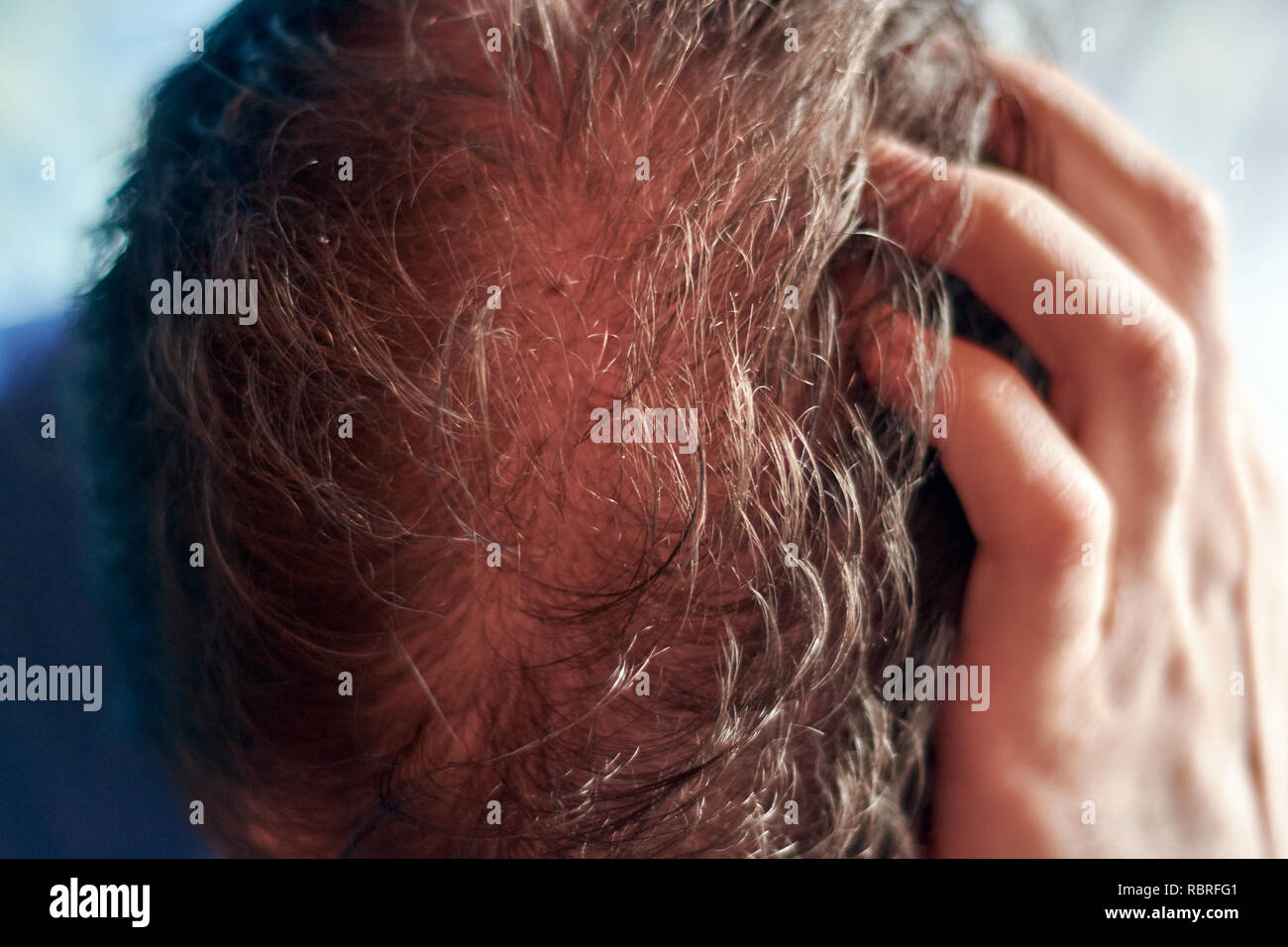 Scalp of young caucasian man seen from above and showcasing a hair loss problem. Stock Photo