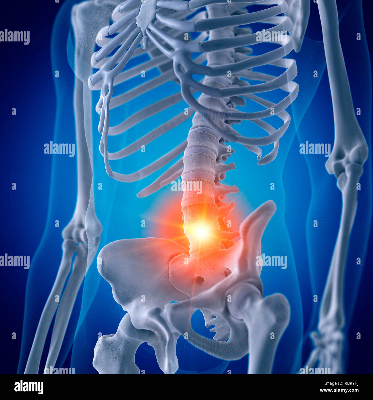 Illustration of a painful lumbar spine Stock Photo - Alamy