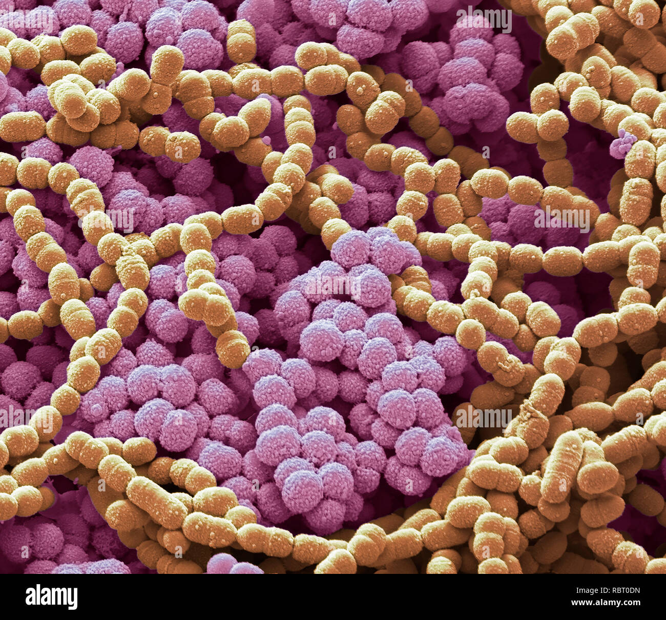 Sputum. Scanning electron micrograph (SEM) of a bacterial culture from sputum. Phlegm is a secretion in the airway during disease and inflammation. Ph Stock Photo