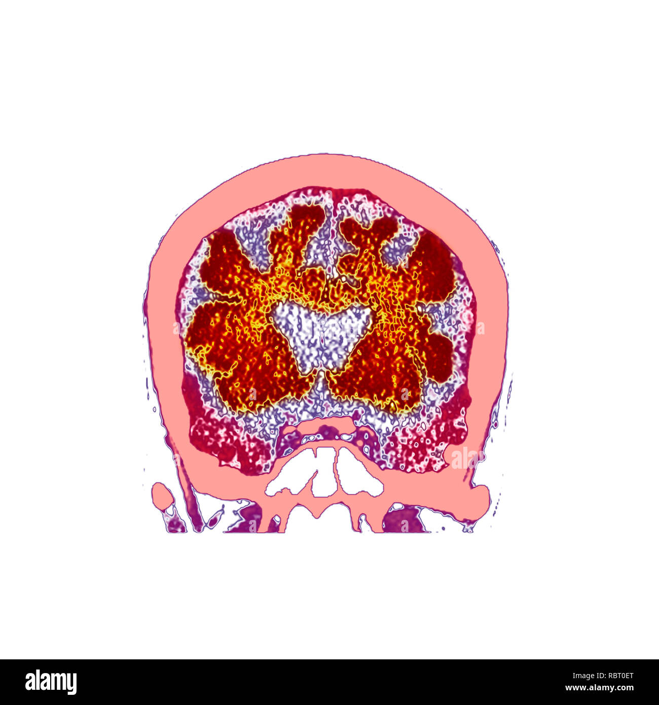 Brain in dementia. Coloured computed tomography (CT) scan of a section through the brain of an 89-year-old male patient with dementia. The brain has atrophied (shrunk), shown by the enlarged central ventricles and deep indentations around the brain's edges. Stock Photo