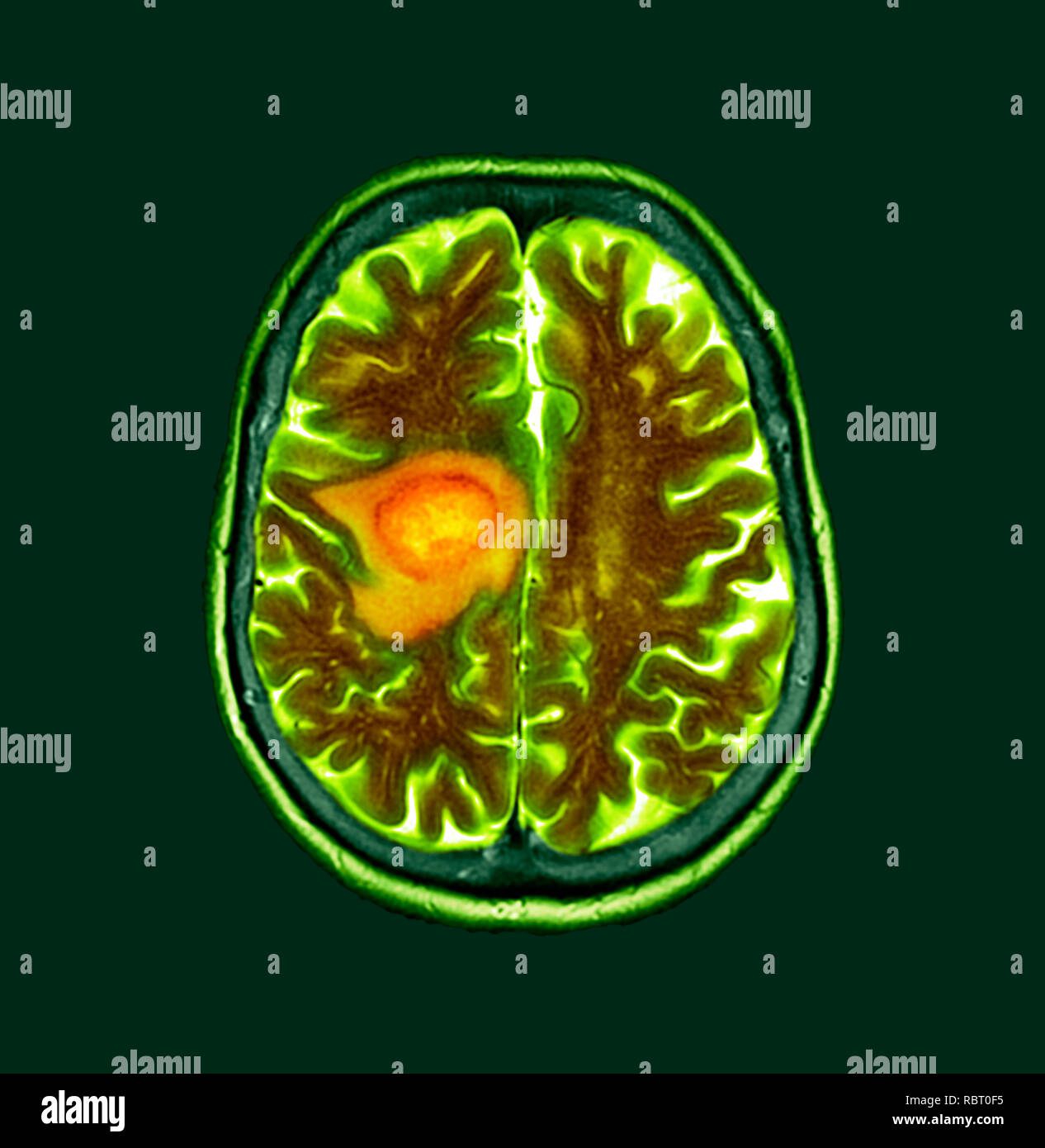 Glioblastoma brain cancer. Coloured computed tomography (CT) scan of a section through the brain of an 84-year-old female patient with glioblastoma (dark, left). Glioblastoma is the most aggressive form of brain cancer. Treatment involves surgery, after which chemotherapy and radiation therapy are used. However, the cancer usually reoccurs despite treatment and the most common length of survival after diagnosis is 12-15 months. Without treatment, survival is typically 3 months. Stock Photo