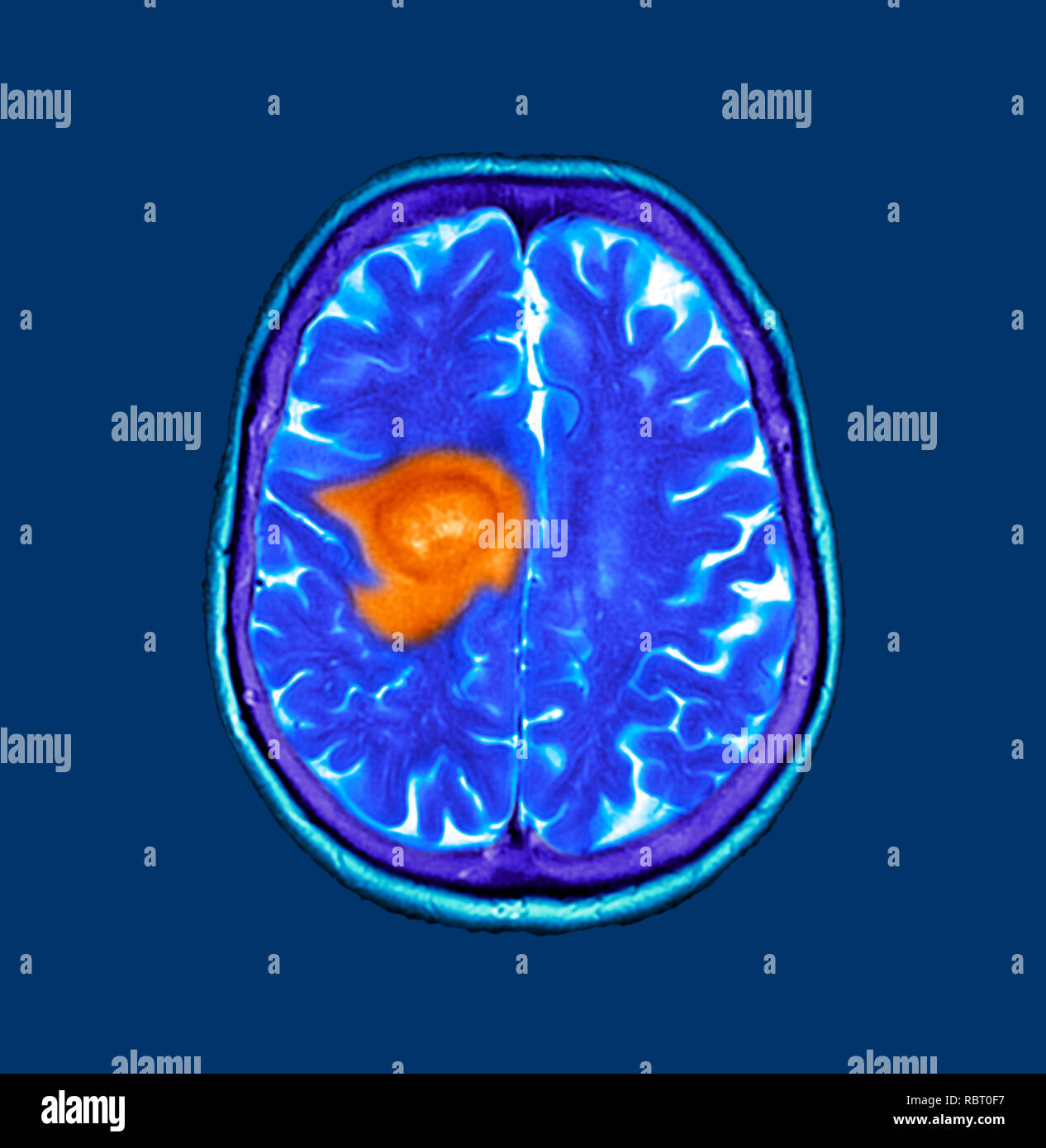 Glioblastoma brain cancer. Coloured computed tomography (CT) scan of a section through the brain of an 84-year-old female patient with glioblastoma (dark, left). Glioblastoma is the most aggressive form of brain cancer. Treatment involves surgery, after which chemotherapy and radiation therapy are used. However, the cancer usually reoccurs despite treatment and the most common length of survival after diagnosis is 12-15 months. Without treatment, survival is typically 3 months. Stock Photo