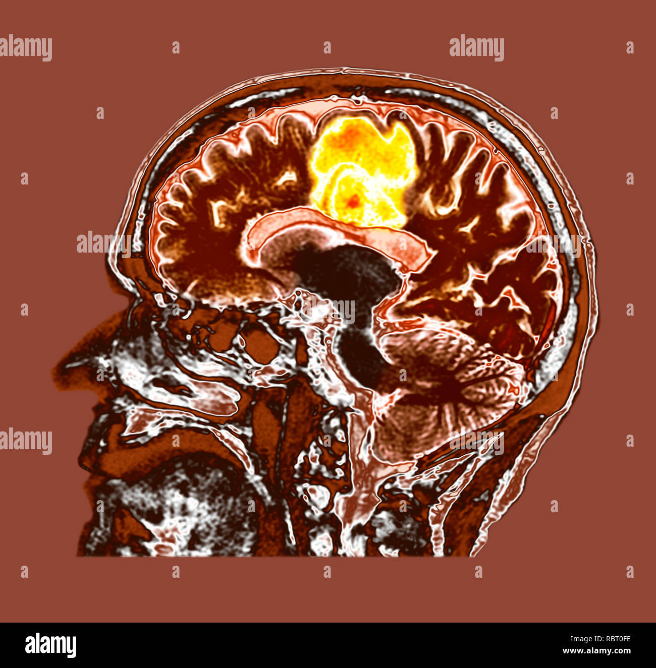 Glioblastoma brain cancer. Coloured computed tomography (CT) scan of a section through the brain of an 84-year-old female patient with glioblastoma (yellow, top). Glioblastoma is the most aggressive form of brain cancer. Treatment involves surgery, after which chemotherapy and radiation therapy are used. However, the cancer usually reoccurs despite treatment and the most common length of survival after diagnosis is 12-15 months. Without treatment, survival is typically 3 months. Stock Photo