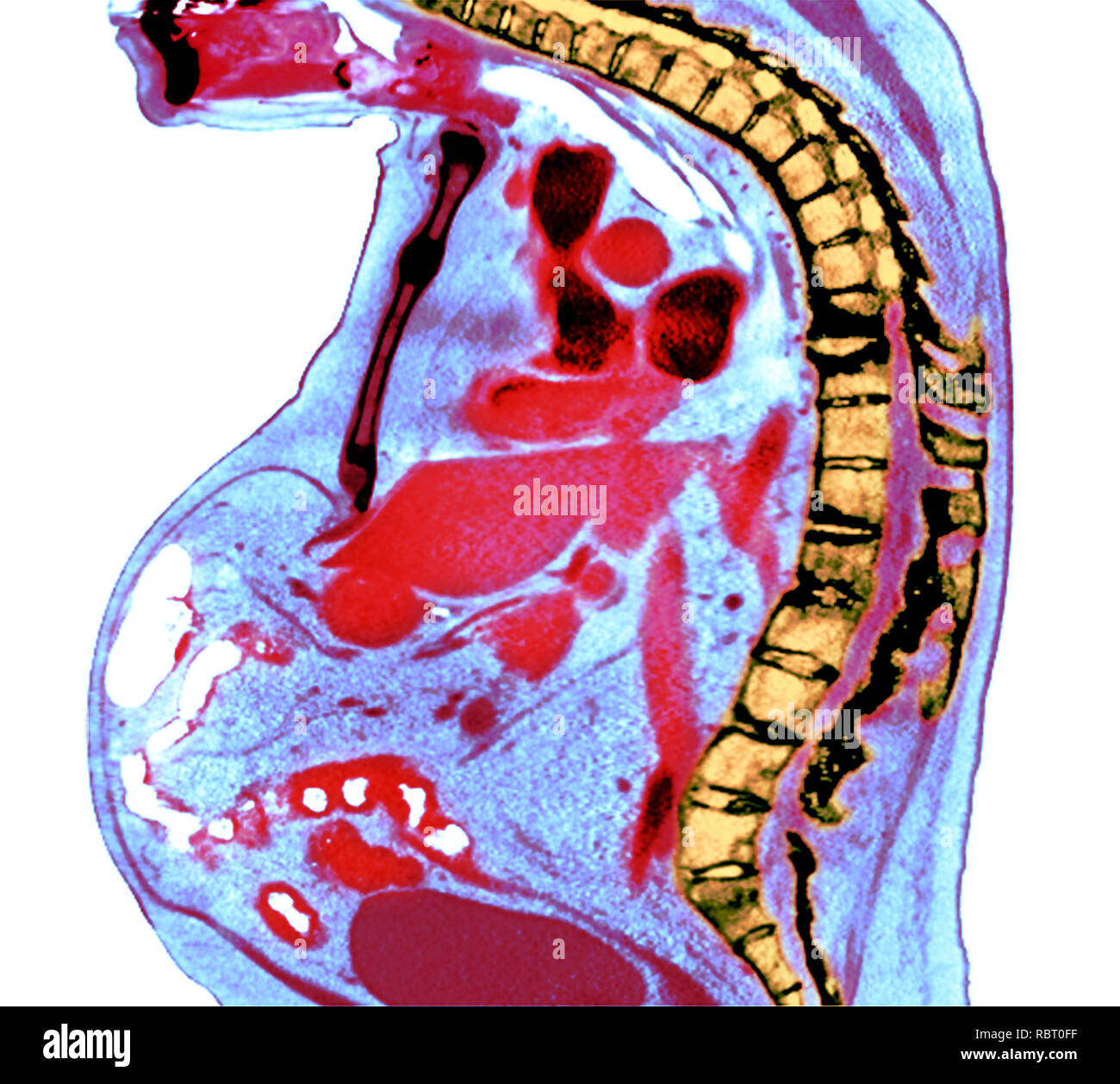 Spine in ankylosing spondylitis. Coloured X-ray of a section through the thoracic spine of a 74-year-old male patient with ankylosing spondylitis, sho Stock Photo