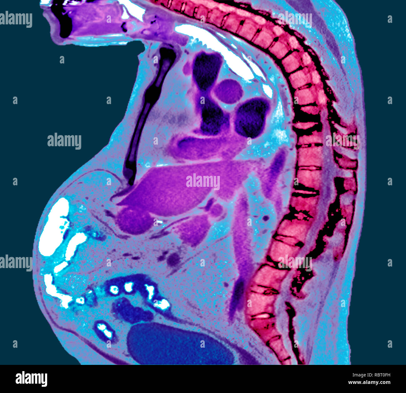 Spine in ankylosing spondylitis. Coloured X-ray of a section through the thoracic spine of a 74-year-old male patient with ankylosing spondylitis, sho Stock Photo