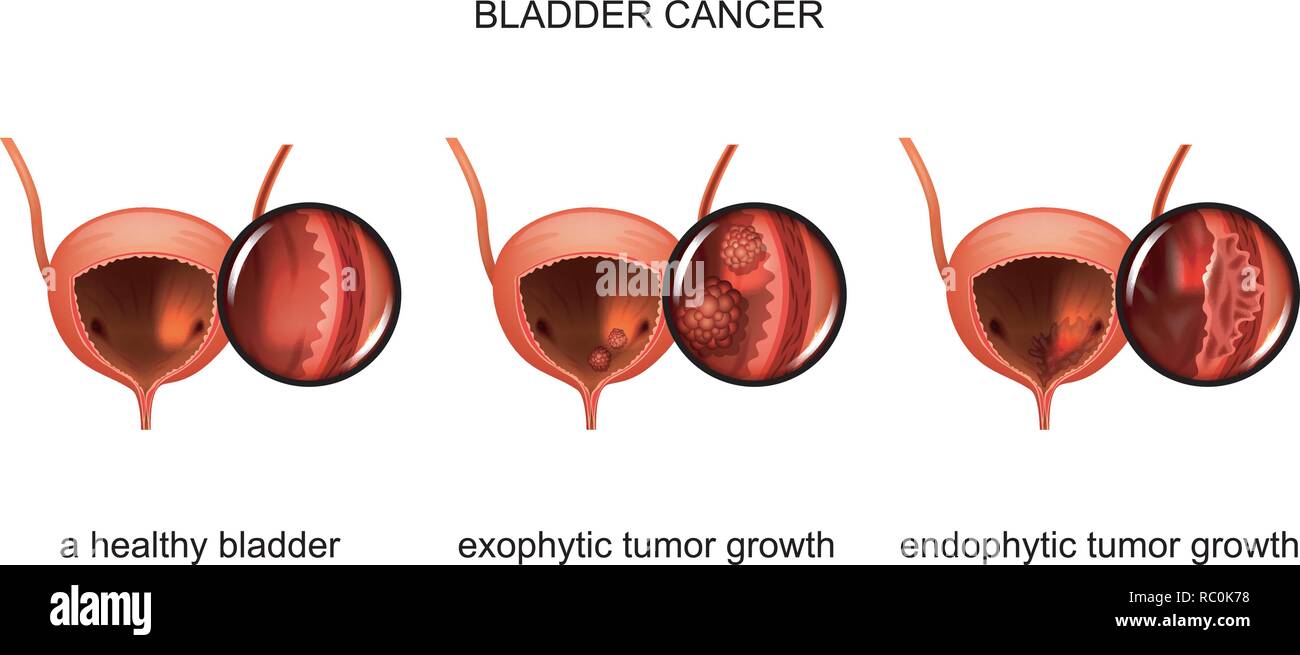 vector illustration of exophytic and endophytic growth of cancer in the ...