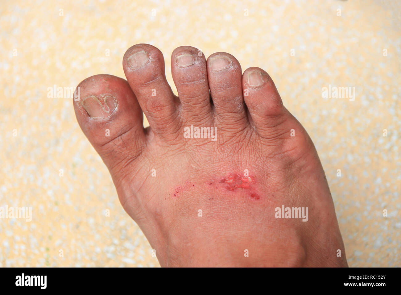 foot wound becomes infected select focus with shallow depth of field ...