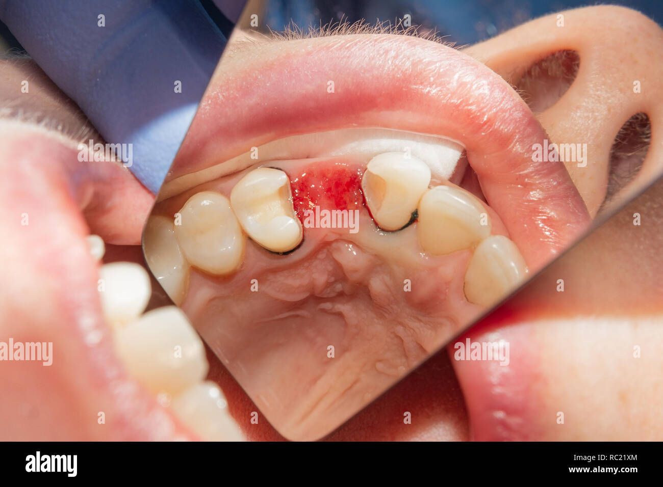 restoration of teeth after endodontic treatment with fiberglass pins. The concept of aesthetic orthopedic dentistry Stock Photo