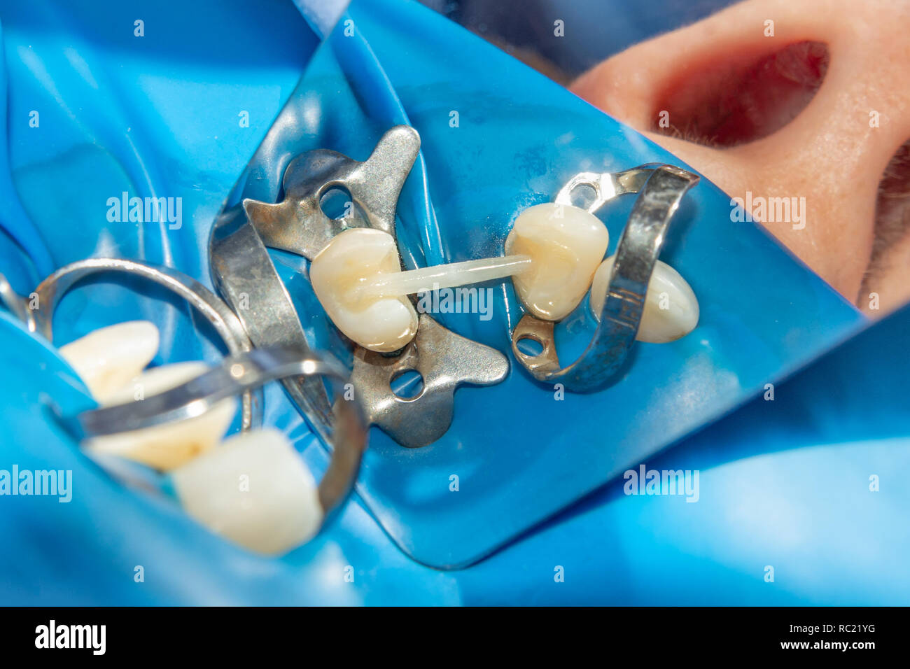 restoration of teeth after endodontic treatment with fiberglass pins. The concept of aesthetic orthopedic dentistry Stock Photo