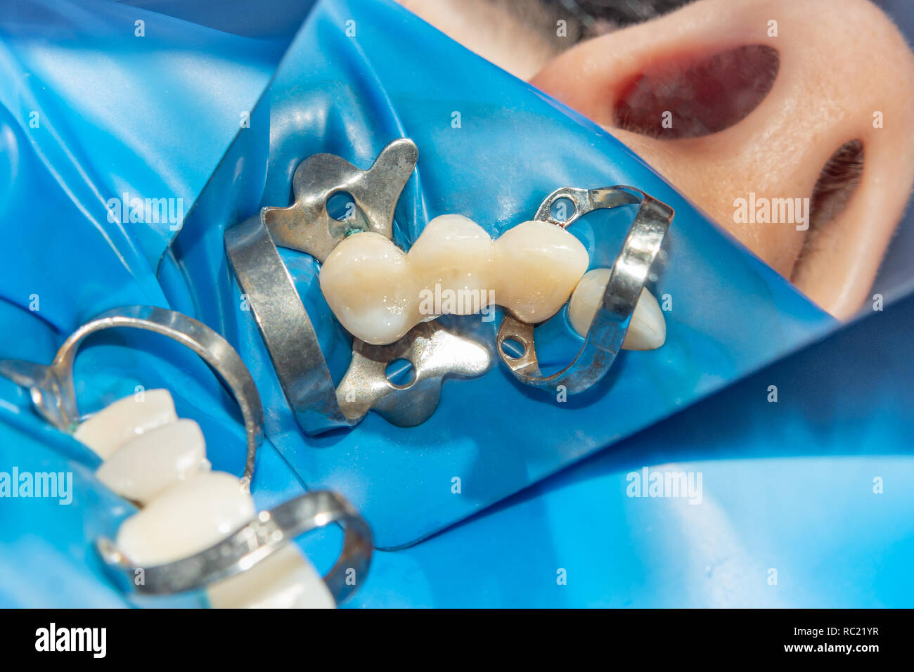 restoration of teeth after endodontic treatment with fiberglass pins
