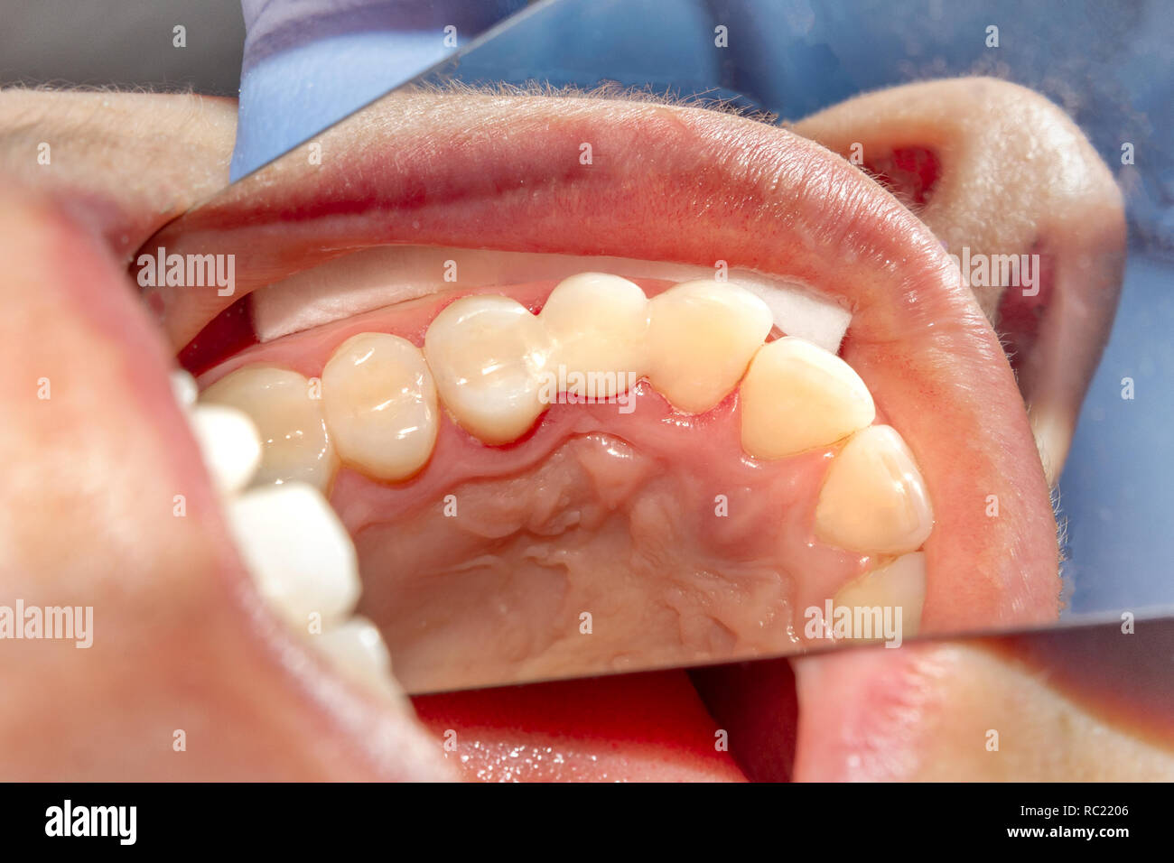 restoration of teeth after endodontic treatment with fiberglass pins. The concept of aesthetic orthopedic dentistry Stock Photo