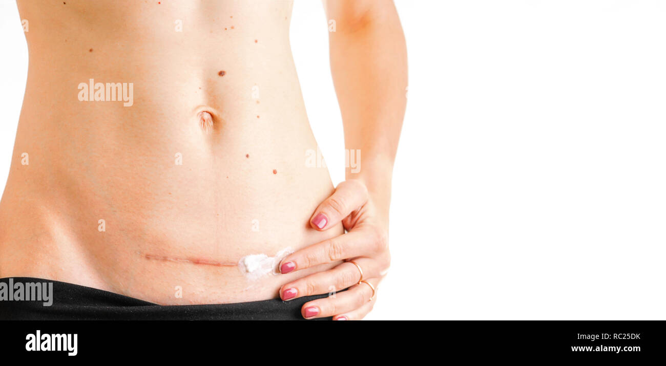 Cesarean Scar Stock Photos & Cesarean Scar Stock Images Alamy