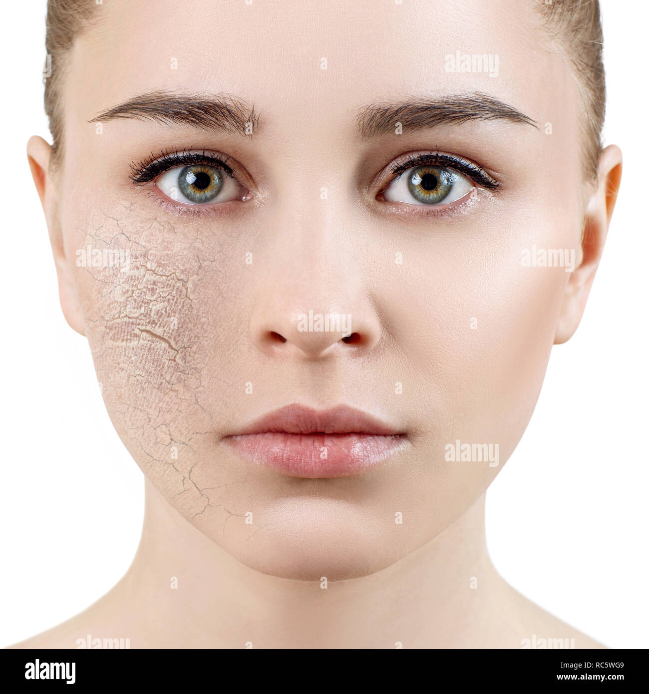 Young woman with dehydrated skin. Stock Photo