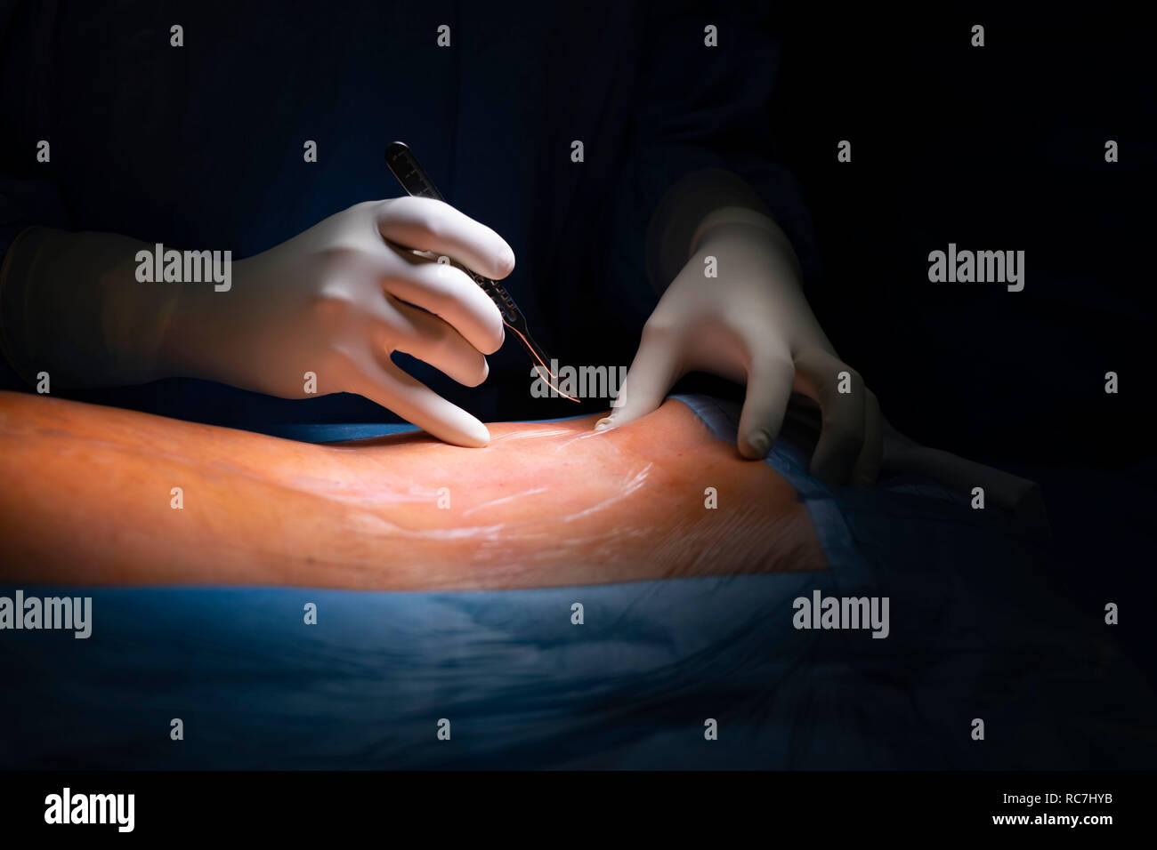 Detail of surgeon waiting to perform the first cut with a scalpel during a surgery at the hospital operating room Stock Photo