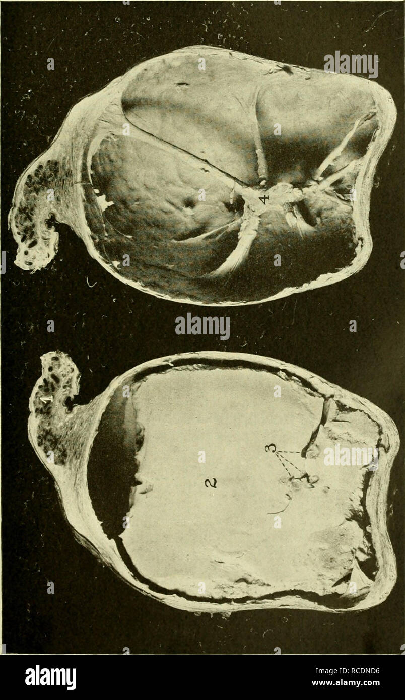Orchitis hi-res stock photography and images - Alamy