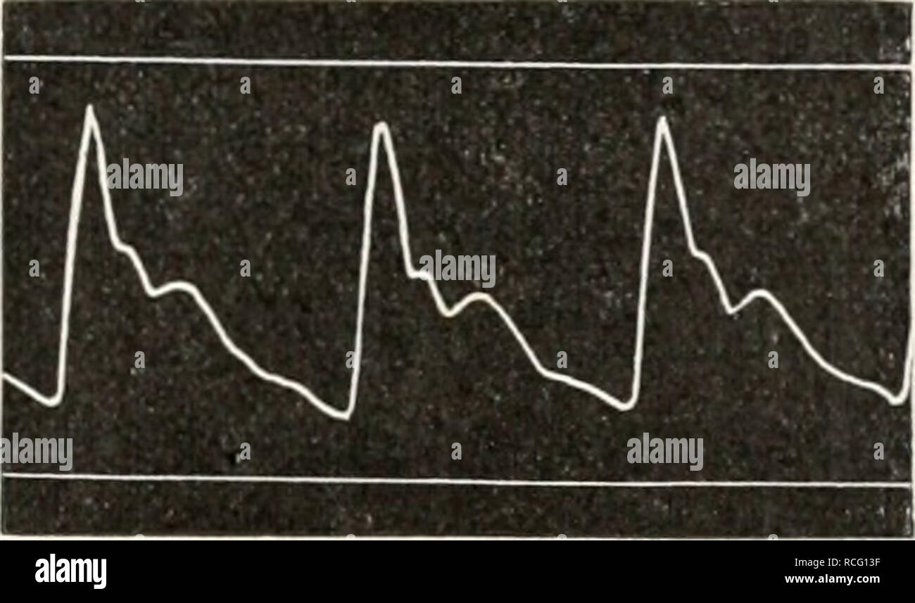. Die Physiologie des Kreislaufes. Cardiovascular system. Die Strömung des Blutes in den Arterien. 4. Der Arterienpuls. 193 Die mit dem Sphygmograplieii 11 von Marey gezeichnete Kurve ist wesent- licli durch zu starke Reibung entsteht und die Kurve hinkt daher inmier nach. Infolge der starken Dämpfung ist ein Auftreten von Eigenschwingungen nicht zu bemerken und die Trägheit der Masse hat hier sogar eine gimstige Wirkung, indem sie über die kleineren Rauhigkeiten hinweghilft. Bei dem Apparate nach v. Frey sind die Kurven gut abgerundet, aber in ihrem ganzen Verlauf verspätet und nach obeji ver Stock Photo